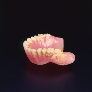 Upper denture with calculus buildup before cleaning with Denture Brite Denture and Orthodontic extra strength denture cleaner